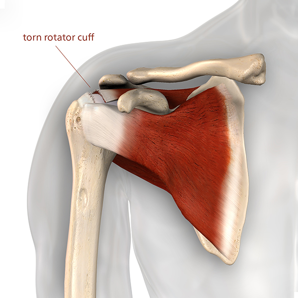 Acute vs. Chronic Rotator Cuff Tear: What's the Difference
